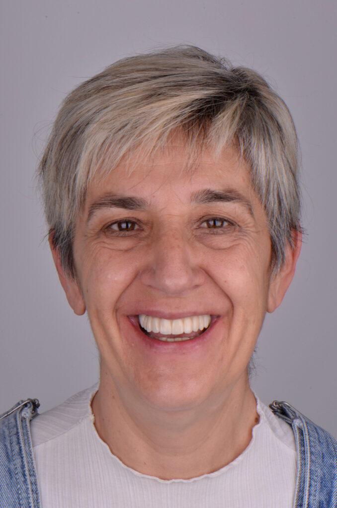 Caso clinico implantes dentales 1