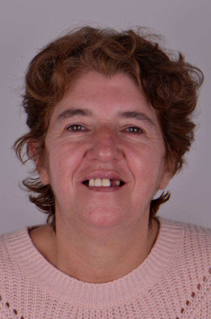 Caso clinico implantes dentales 10