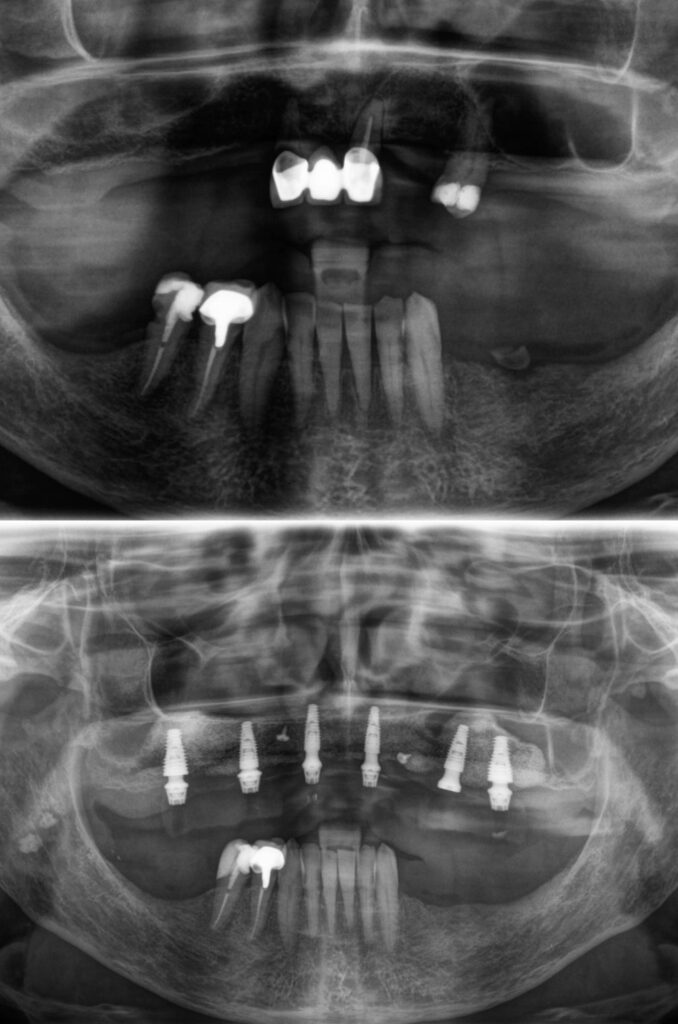 Caso clinico implantes dentales 12