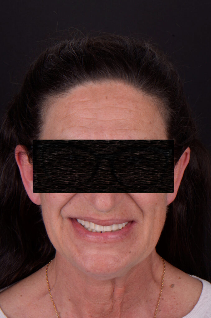 Caso clinico implantes dentales 7