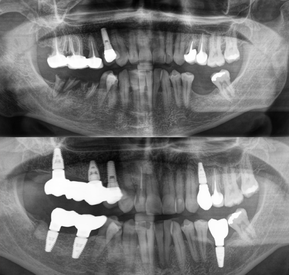 carga inmediata implantes 1implantes dentales