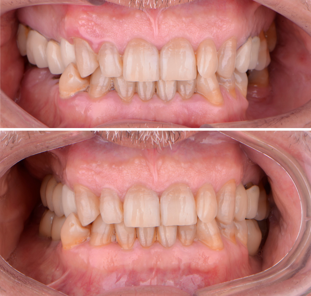 carga inmediata implantes dentales 6